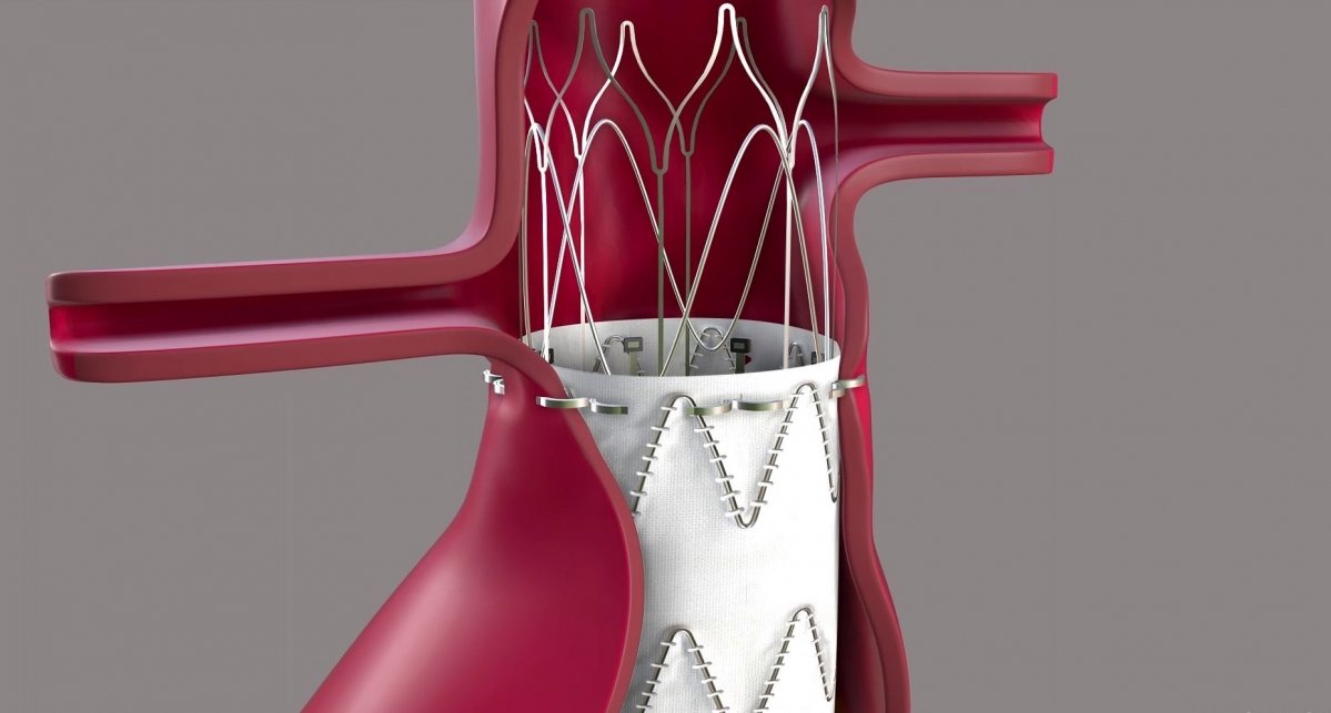 © Endoron Medical © Endoron Medical